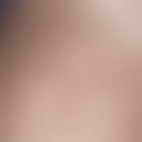 Incontinentia pigmenti, Typ Bloch-Sulzberger. Girlandenförmige Pigmentierung am Oberschenkel der ...