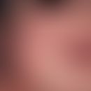 Infantiles akrolokalisiertes papulo-vesikulöses Syndrom. Rötliche Papeln mit Umgebungserythem im ...