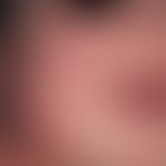 Infantiles akrolokalisiertes papulo-vesikulöses Syndrom. Rötliche Papeln mit Umgebungserythem im ...