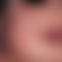 Infantile acrolocalized papulo-vesicular syndrome, reddish papules with environmental erythema in...