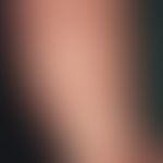 Infantiles akrolokalisiertes papulo-vesikulöses Syndrom. Papulo-vesikulöses Exanthem mit Umgebung...