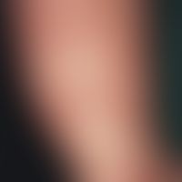 Infantile acrolocalized papulo-vesicular syndrome: Papulo-vesicular exanthema with environmental ...