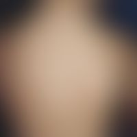 Infantile acrolocalized papulo-vesicular syndrome, diffuse seeding of multiple papules and papulo...