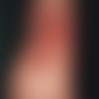 Infantile acrolocalized papulo-vesicular syndrome: Multiple, partially confluent papules and papu...