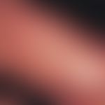 Infantiles akrolokalisiertes papulo-vesikulöses Syndrom. Multiple rote, teils leicht hämorrhagisc...