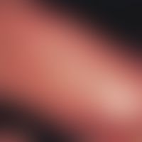Infantile acrolocalized papulo-vesicular syndrome: Multiple red, partly slightly hemorrhagic papu...