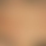 Insektenstiche:&nbsp;disseminierte, 0,2-0,3 cm große, rote, heftig juckende Papeln und Papulo-Ves...
