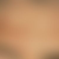 Insektenstiche:&nbsp;disseminierte, 0,2-0,3 cm große, rote, heftig juckende Papeln und Papulo-Ves...
