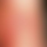Insektenstich. Insektenstichreaktion am Unterschenkel mit nekrotisierendem Stichkanal und sich ri...