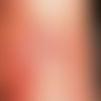 Insektenstich. Insektenstichreaktion am Unterschenkel mit nekrotisierendem Stichkanal und sich ri...