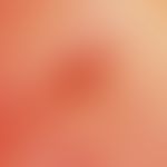 Insektenstich. Auflichtmikroskopie: Insektenstich am Unterschenkel bei einer jungen Frau. Zentral...