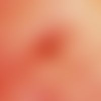 Insektenstich. Auflichtmikroskopie: Insektenstich am Unterschenkel bei einer jungen Frau. Zentral...