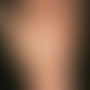 Irisblendenphänomen. Akrozyanose mit rundlichem abgeblassten Areal nach Anämisierung mittels Fing...