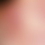 Janeway's patches. Petechiae and ecchymosis of the palm in a 42-year-old woman with endocarditis ...