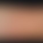 Cold urticaria. solitary, acute, on the right arm localized, approx. 5.0 x 7.0 cm measuring, flat...