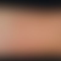 Cold urticaria. solitary, acute, on the right arm localized, approx. 5.0 x 7.0 cm measuring, flat...