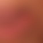 Carcinoma of the lips: The lateral third of the left lip, broadly seated, firm, painless, verruco...