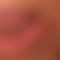 Carcinoma of the lips: The lateral third of the left lip, broadly seated, firm, painless, verruco...