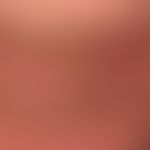 Carcinoma, carcinoma of the lip (spinocellular carcinoma of the lower lip, existing for years) Sm...