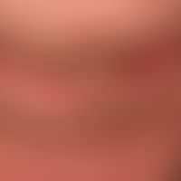 Carcinoma, carcinoma of the lip (spinocellular carcinoma of the lower lip, existing for years) Sm...