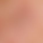 Squamous cell carcinoma of the skin: a red, very firm, painless lump on actinic damaged skin that...
