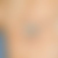 Plattenepithelkarzinom der Haut: scharf begrenzte, auf der Unterlage gut verschiebliche, zentral ...
