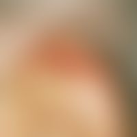 Squamous cell carcinoma of the skin: hyperkeratotic, sharply defined red nodule which is painful ...