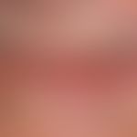 Squamous cell carcinoma of the skin: the left half of the lower lip is surrounded by a sharply de...