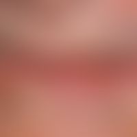 Squamous cell carcinoma of the skin: the left half of the lower lip is surrounded by a sharply de...