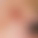 Squamous cell carcinoma of the skin: slowly growing for 6 months, sliding on the surface, 2.0 cm ...
