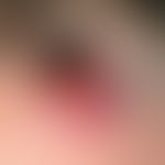 Squamous cell carcinoma of the skin: 1.5 cm large, spherical, red node (tumor) with ulcerated sur...