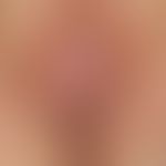 Squamous cell carcinoma of the skin (vulva carcinoma): chronically active, ulcerated plaque on th...