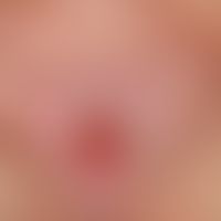 Plattenepithelkarzinom der Haut, Detailvergrößerung: seit ca. 8 Monaten zunehmend wachsende, ca. ...
