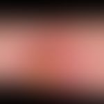 Squamous cell carcinoma of the skin: chronically persistent, for several years existing, slowly p...