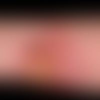 Squamous cell carcinoma of the skin: chronically persistent, for several years existing, slowly p...