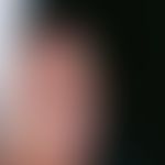 Squamous cell carcinoma of the skin: solitary, since 1 year continuously growing, 2.2 cm large, s...