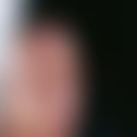 Squamous cell carcinoma of the skin: solitary, since 1 year continuously growing, 2.2 cm large, s...