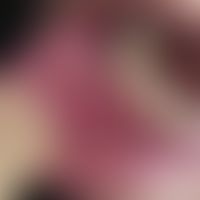 Carcinoma of the mucous membrane: centrally ulcerated, painless, slow-growing, rough, hard lump, ...