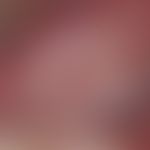 Squamous cell carcinoma of the skin: chronically stationary (imperceptible growth) for 2 years, 1...