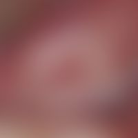 Squamous cell carcinoma of the skin: chronically stationary (imperceptible growth) for 2 years, 1...