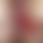 Squamous cell carcinoma of the skin: painless, flat, ulcerated, weeping, plate-like ulcer of coar...