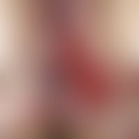 Plattenepithelkarzinom der Haut: auf einem vorbestehendem Lichen sclerosus et atrophicus entstand...