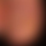 Squamous cell carcinoma of the skin: carcinoma of the nail bed, which was misjudged as a fungal d...