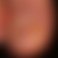 Squamous cell carcinoma of the skin: carcinoma of the nail bed, which was misjudged as a fungal d...