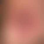 Squamous cell carcinoma of the skin: Keratoacanthoma-like, painless, centrally ulcerated red nodu...