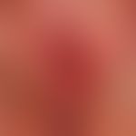 Squamous cell carcinoma of the skin: ulcerated, temporarily painful and burning, erosive plaque o...
