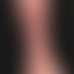 squamous cell carcinoma of the skin: advanced ulcerated carcinoma. previously misinterpreted as a...