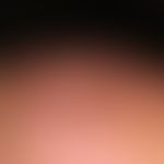 Squamous cell carcinoma in actinically damaged skin; for more than 1 year, slowly growing, bowl-s...
