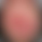 Squamous cell carcinoma of the skin: large-area desmoplastic carcinoma of the scalp, which extend...