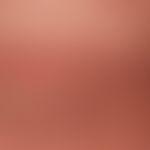 Squamous cell carcinoma of the skin (lip carcinoma): ulcerated, broad-based, painless lump of the...